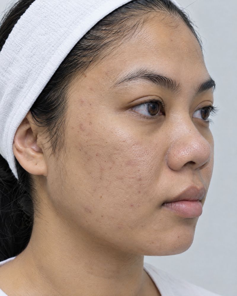 Illustration: the same cheek with smoother texture