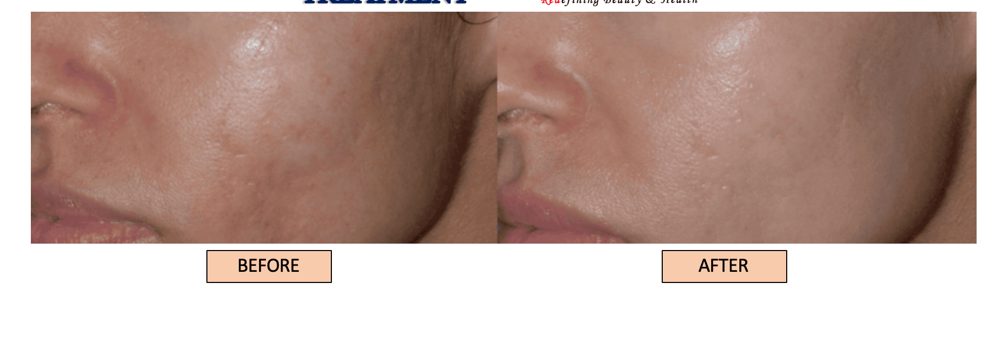 Klinik Dr Inder patient, skin tone before and after Pico laser